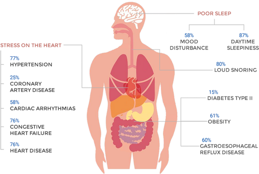 Diagram showing health effects of snoring and sleep apnoea including hypertension, heart disease, mood disturbance, daytime sleepiness, diabetes, and obesity